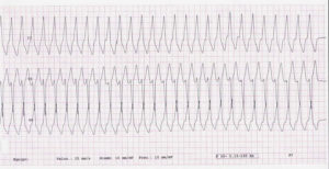 electrocardiograma
