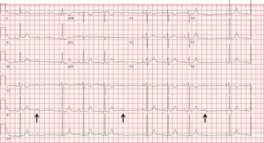 electrocardiograma