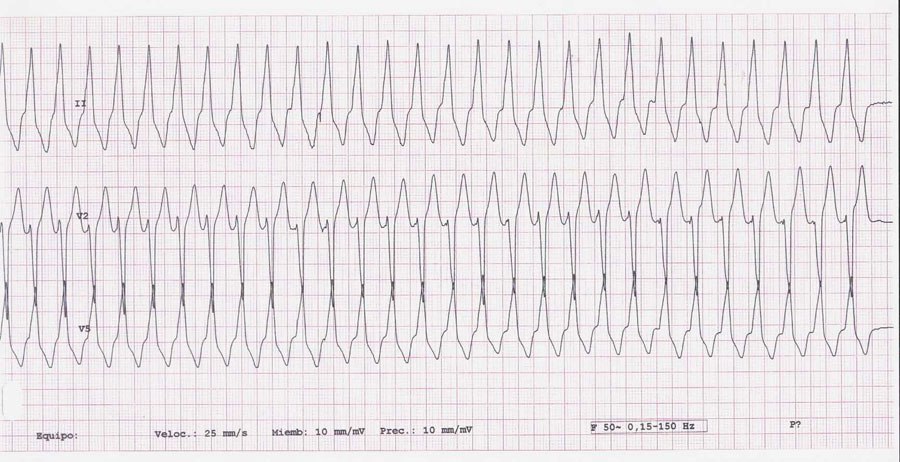 electrocardiograma